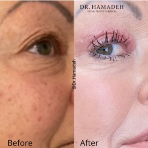 Before and after blepharoplasty transformation, showcasing a person's eyelid surgery results